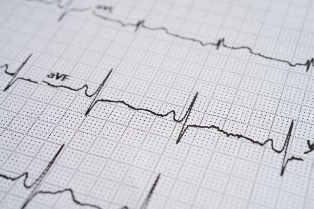 istock Electrocardiogram (ECG), heart wave, heart attack, cardiogram report. 2182293254