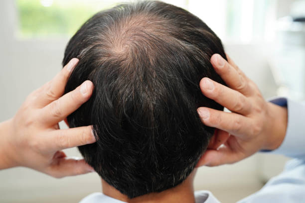 istock Bald head in man, hair loss treatment health problem. 2182293287