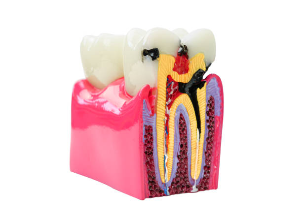 istock Dental implant, artificial tooth roots into jaw human model isolated on white background with clipping path. 2182313373