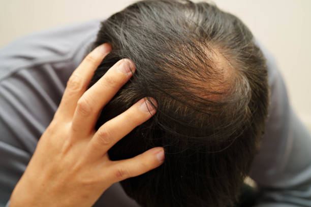 istock Bald head in man, hair loss treatment health problem. 2182313455