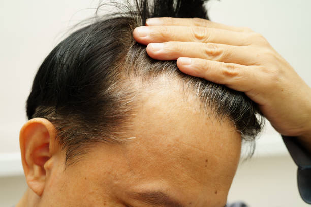 istock Bald head in man, hair loss treatment health problem. 2182313471