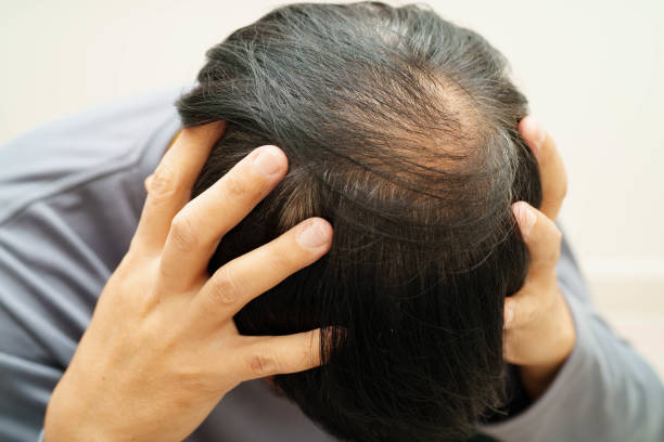 istock Bald head in man, hair loss treatment health problem. 2182313762
