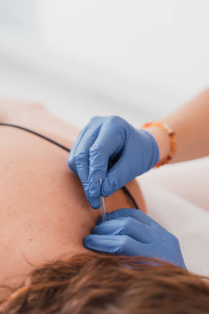 istock Physiotherapist applying dry needling technique on patient's back for pain relief 2182349261