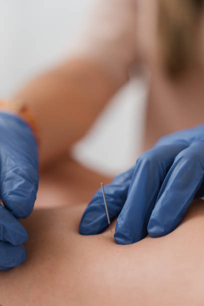 istock Physiotherapist applying dry needling therapy to patient's back 2182351459