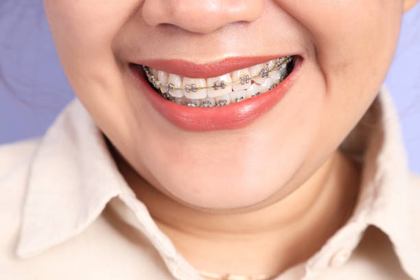 istock Woman with Braces 2182982916