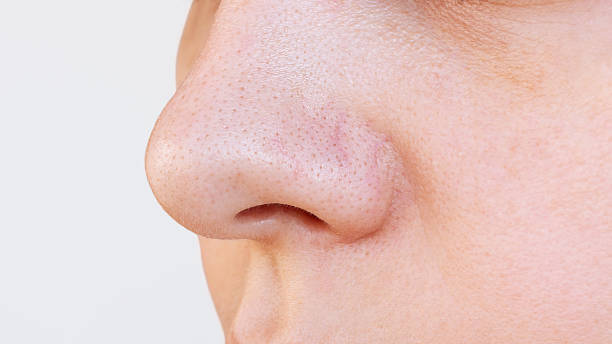 istock Young woman's nose with black heads or black dots on a white background. Acne problem, comedones 2183008024