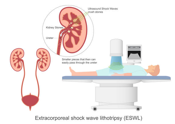 50+ Shock Wave Lithotripsy Stock Photos, Pictures & Royalty-Free Images