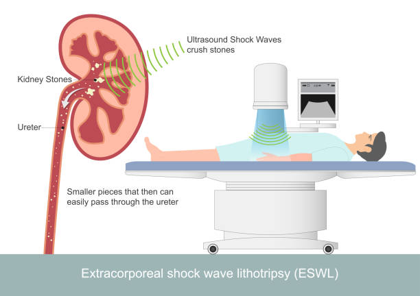 litotrypse je neinvazivní zákrok. - rázová vlna stock ilustrace