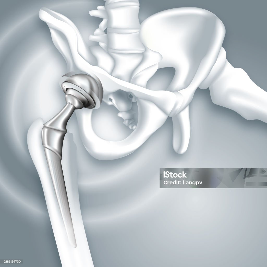 Hip Rast Hip Arthroplasty Stock Illustration - Download Image Now - Hip ...