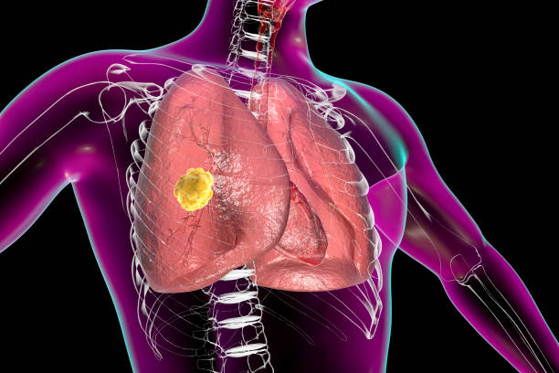 pulmonary mucormycosis, a lung disease caused by fungi mucor, also known as black fungus, illustration - zigomikoz stok fotoğraflar ve resimler