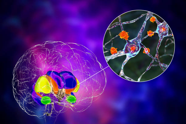 istock Dorsal striatum and its neurons in the Huntington's disease, illustration 2183237856