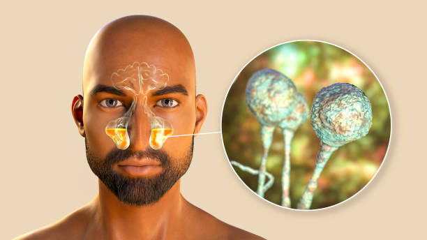 rhinosinusitis caused by mucor fungi, artwork - esporângio - fotografias e filmes do acervo