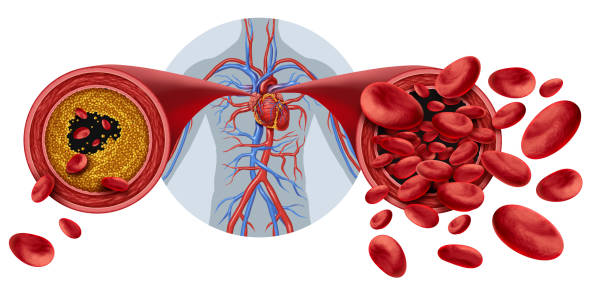 istock Atherosclerosis medical condition 2183365237