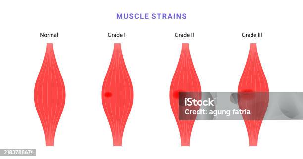 Muscle Gpd Muscle Strain Grading Science Diagram Stock Illustration - Download ...
