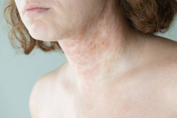 Atopic dermatitis. Eczema. Skin condition. Young woman with atopic dermatitis, type of eczema. psoriasis stock pictures, royalty-free photos & images