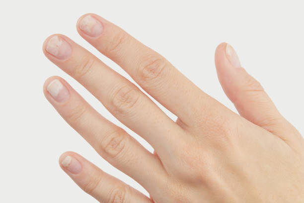 istock Fingernails with onycholysis after removing gel polish on grey background. Womans hand with damaged nails 2184074499