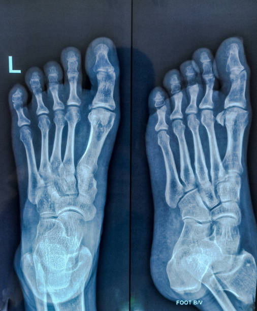 istock X-ray of the human foot both view. No significant skeletal abnormality detected. 2184275165