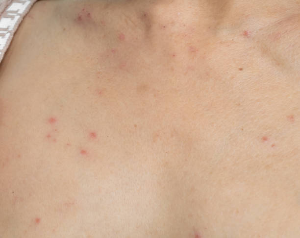 Woman with urticaria allergy itchy rash eczema itch neck from food,air poisoning,cosmetic,health,body vare disease lilness air,dissease medicine calamine lotion treatment,infection pain sick scratch. mujer con urticaria, alergia, erupción cutánea con picazón, eczema, picazón en el cuello por alimentos, envenenamiento del aire, cosméticos, salud, enfermedad del cuerpo, aire lirio, medicina disasa, tratamiento con loción de calamina, infección, do