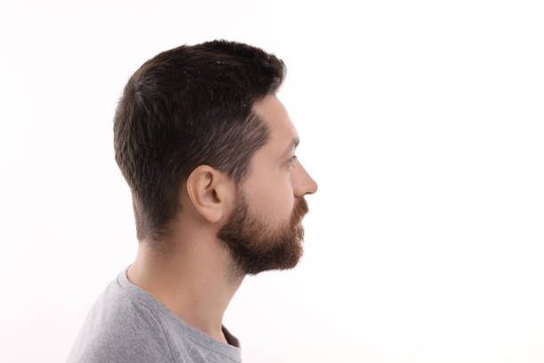 Man with dandruff in his dark hair on white background
