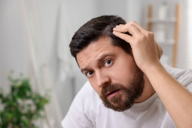 istock Man with dandruff in his dark hair at home, space for text 2184422032