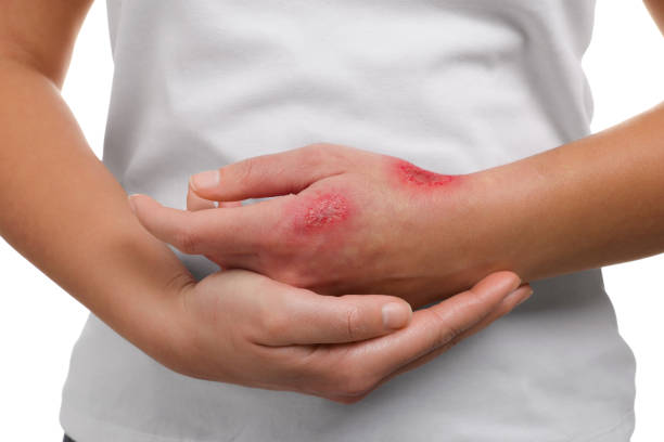 istock Woman with burned hand on white background, closeup 2184464481
