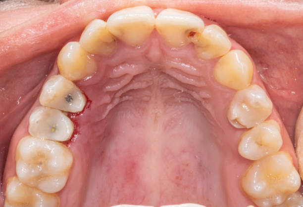 istock Occlusal view of a complete upper maxillary arch with restored teeth. 2184633187