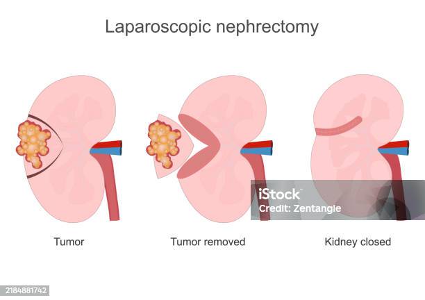Nephrectomy Nephrectomy Is A Major Procedure Performed Stock Illustration ...