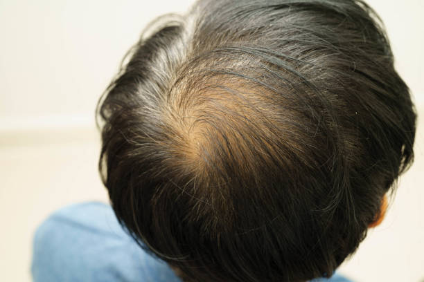 istock Bald head in man, hair loss treatment health problem. 2184927341