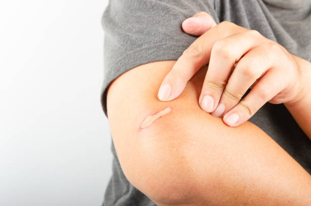 istock Arm scald Wounds caused by scalding hot water Wound inflammation 2185079563