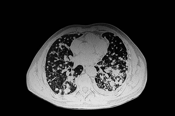istock CAT Scan Metastatic lung adenocarcinoma 2185151674