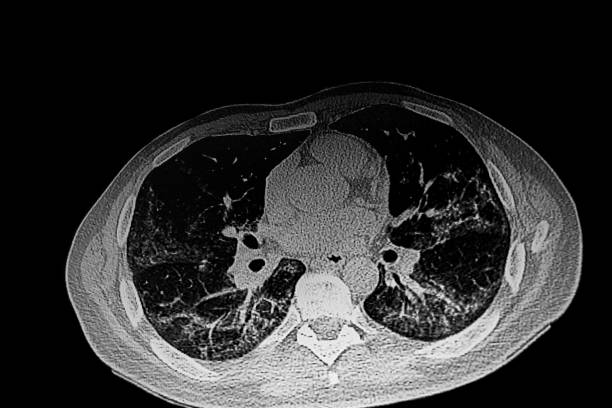 istock CAT Scan Metastatic lung adenocarcinoma 2185151730