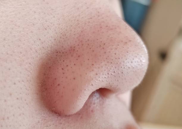 Nose full of Blackhead, Open Comedone and Acne