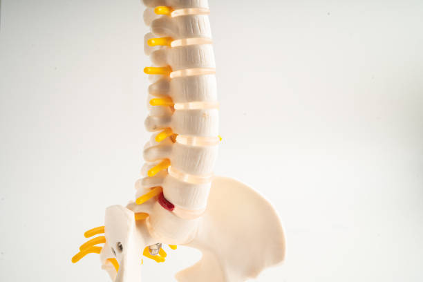istock Lumbar spine displaced herniated disc fragment, spinal nerve and bone. Model for treatment medical in the orthopedic department. 2185518582