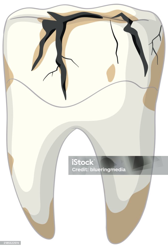 Illustration Of A Cracked Decayed Tooth Stock Illustration - Download ...