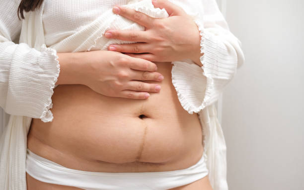 istock Scar on the abdomen after cesarean section. 2185555109