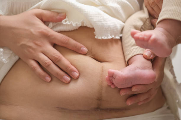 istock Scar on the abdomen after cesarean section. 2185555802