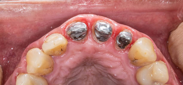 istock Occlusal view of prosthodontics dentistry 2185806438