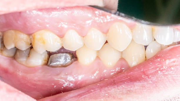istock Prosthodontic metallic post and core build-up on a lower molar 2185806599