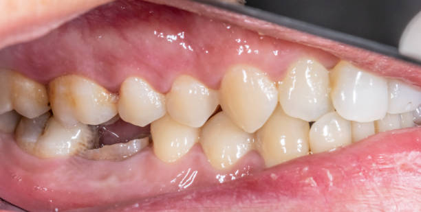 istock Lateral view of dental arches in occlusion with a lower molar decayed and destroyed crown. 2185807605