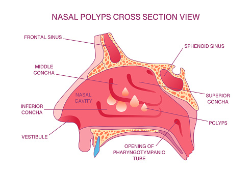 Polypose Labeled Nasal Polyps Crosssection Diagram Nasal Cavity Sinuses Concha ...