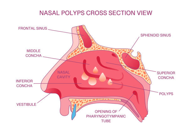 Polypose 1,000+ Nasal Polyp Stock Photos, Pictures & Royalty-Free Images - iStock