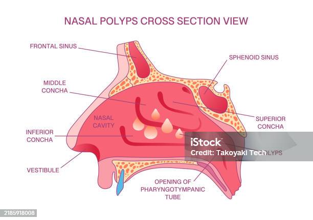 Polypose Labeled Nasal Polyps Crosssection Diagram Nasal Cavity Sinuses Concha ...