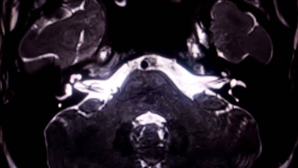 istock MRI Scan for Cochlea of the internal auditory canal (IAC). 2185943160