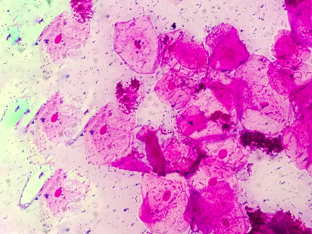 istock High vaginal swab gram stained microscopic show inflamatory epithelal cell and streptococcus Spp. 2185944680