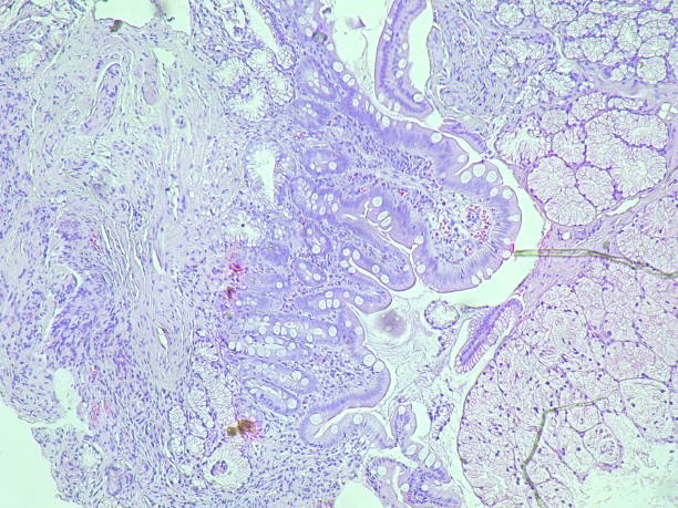 istock Human cell tissue under microscope in pathology laboratory. Microscopic picture of chronic gastric disease showing Helicobacter pylori bacterial infection, hematoxylin eosin staining 2186117771