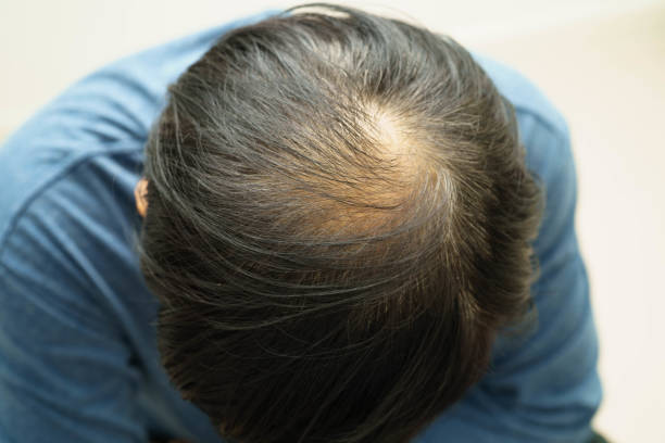 istock Bald head in man, hair loss treatment health problem. 2186354589