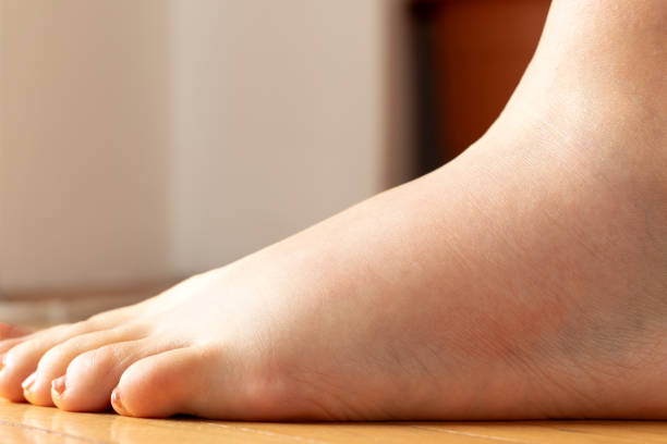 A pair of feet with dry cracked hard heel skin on the floor. healthcare and medical concept.