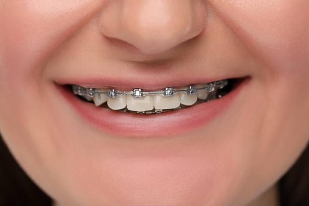 istock Smiling woman with dental braces, closeup view 2186665111