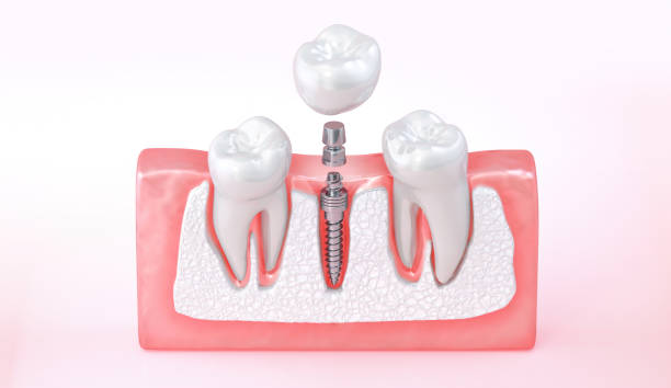 istock Dental teeth implant. Placement of a titanium implant into the jawbone to replace a missing tooth. 2186951147