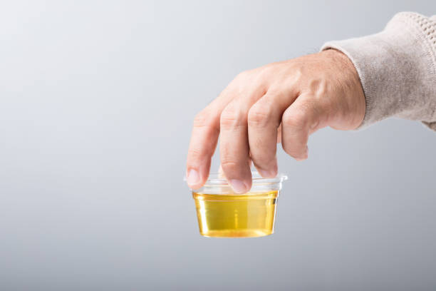 istock Man holds a clear plastic cup containing a urine sample, emphasizing how urine color can reveal important health insights. A reminder of the role of self-monitoring in maintaining wellness 2187092896